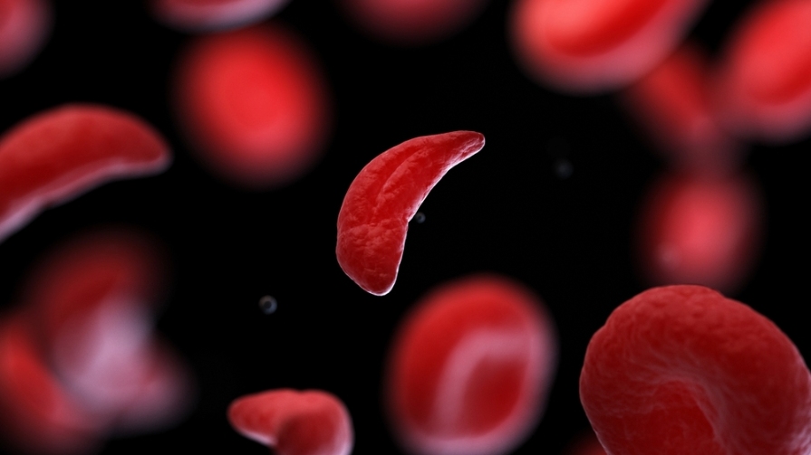 Illustration of red blood cells with sickle cell in focus.
